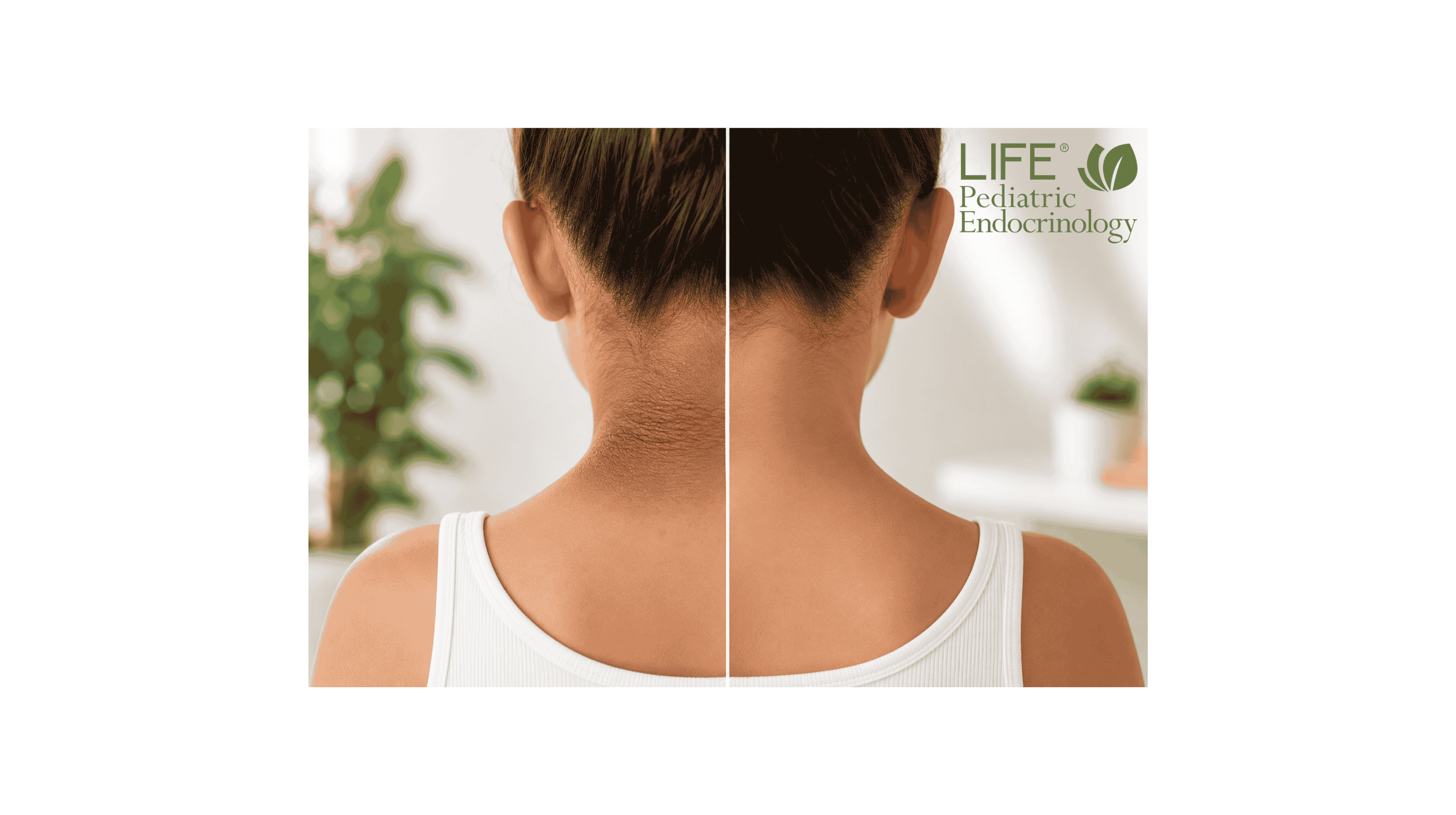 Before-and-after comparison of acanthosis nigricans on a child's neck showing improvement after treatment for insulin resistance and improved metabolic health.