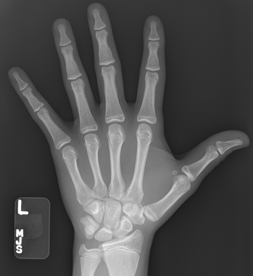 how-to-keep-growth-plates-open-aromatase-inhibitor-almost-fused-bone-age