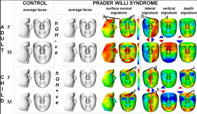 Three-dimensional facial analysis comparing facial features of children and adults with Prader-Willi syndrome and healthy controls, highlighting characteristic facial differences with color-coded heat maps.