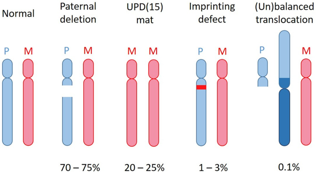 Illustration showing the four genetic causes of Prader-Willi syndrome, including paternal chromosome 15 deletion, maternal uniparental disomy (UPD), imprinting defects, and rare chromosomal translocations.